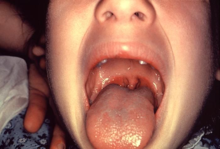 viêm họng liên cầu khuẩn